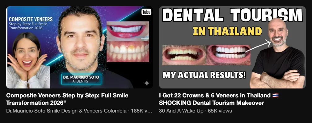 References for a smile makeover video: Dr. Mauricio Soto, Composite Veneers Step by Step, 186K views; 30 And A Wake Up, I Got 22 Crowns and 6 Veneers in Thailand, 65K views