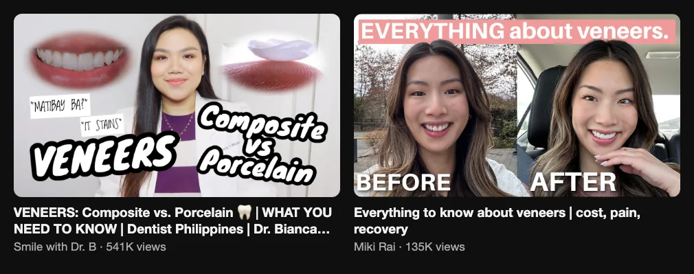 References for a before-veneers video: Smile with Dr. B, Veneers composite vs porcelain, what you need to know, 541K views; Miki Rai, Everything to know about veneers, 135K views