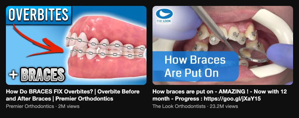 Two reference videos showing braces treatment from start to result, 2M and 23.2M views